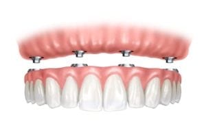 Image showing how All-on-4® dental implants are secured to the gum line. 