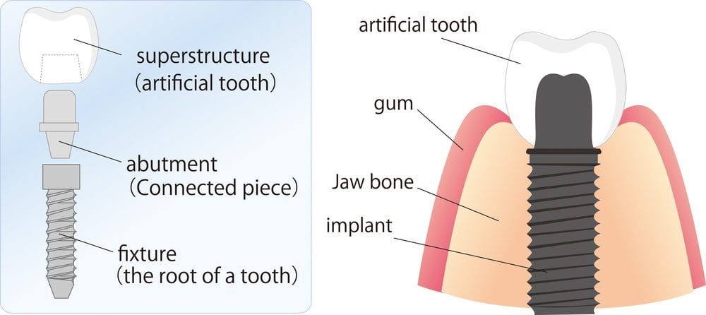 Image of the parts of a dental implant; one of the restorative dentistry services provided by Everlasting Smiles.
