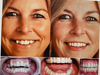 Invisalign Clear Geneseo NY  Clear Aligners Henrietta, Batavia