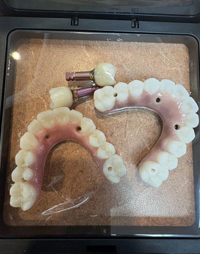 dental restorations used at Everlasting Smiles